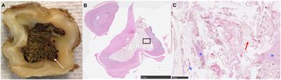 A Comparison of Computed Tomographic, Radiographic, Gross and Histological, Dental, and Alveolar Findings in 30 Abnormal Cheek Teeth from Equine Cadavers